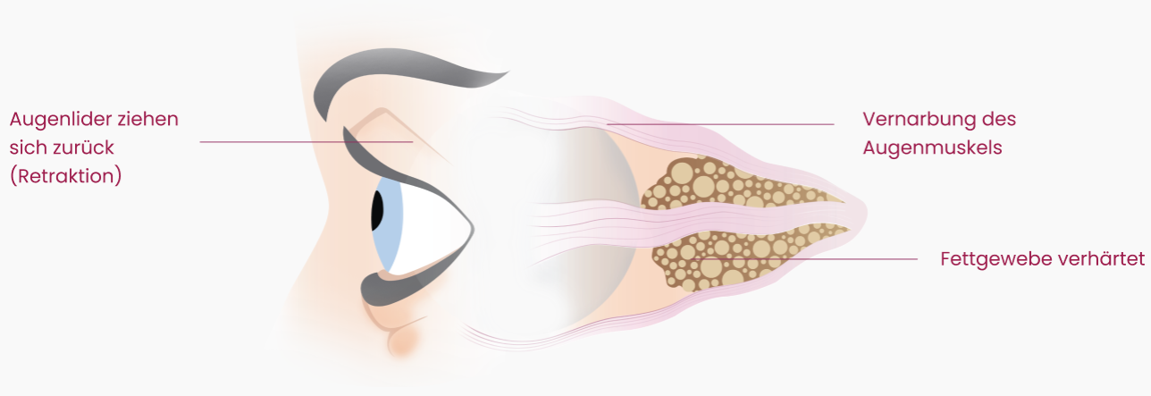 Endokrine Orbitopathie | Chronische Phase der Erkrankung